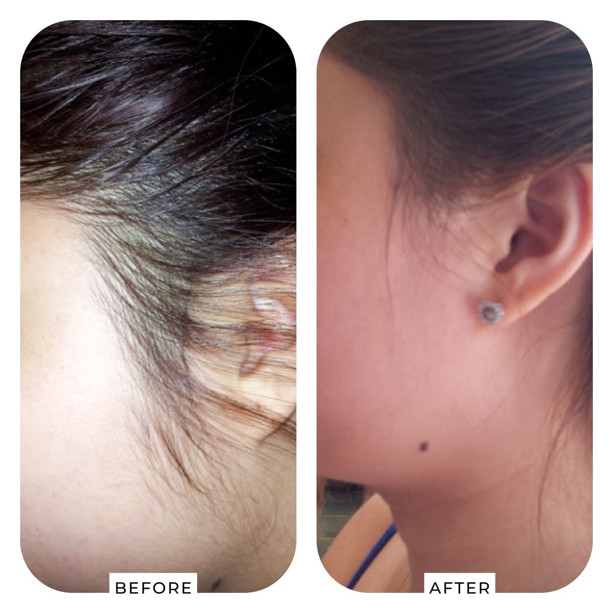 Laser Hair Removal before and after results