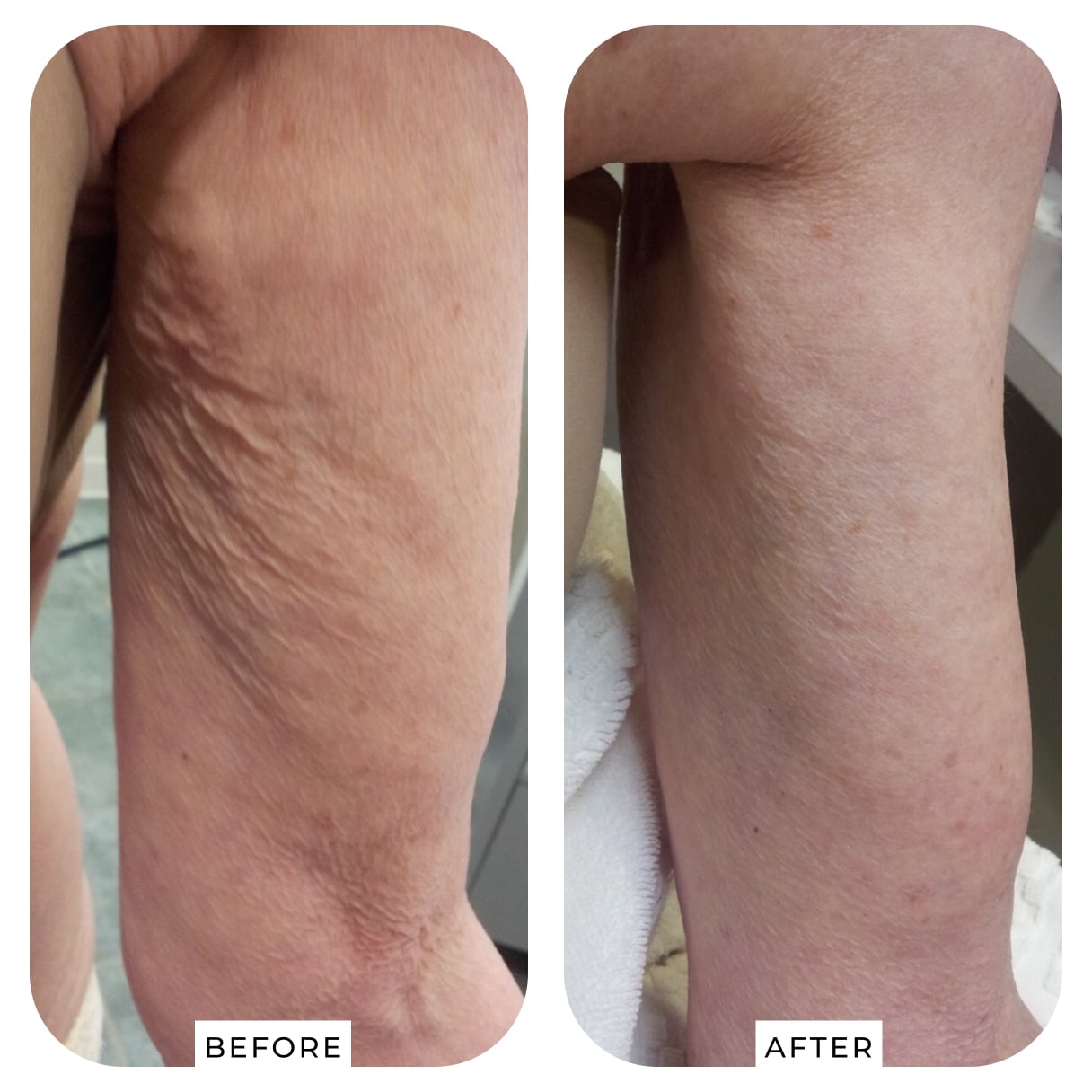 After — PelleFirm™
