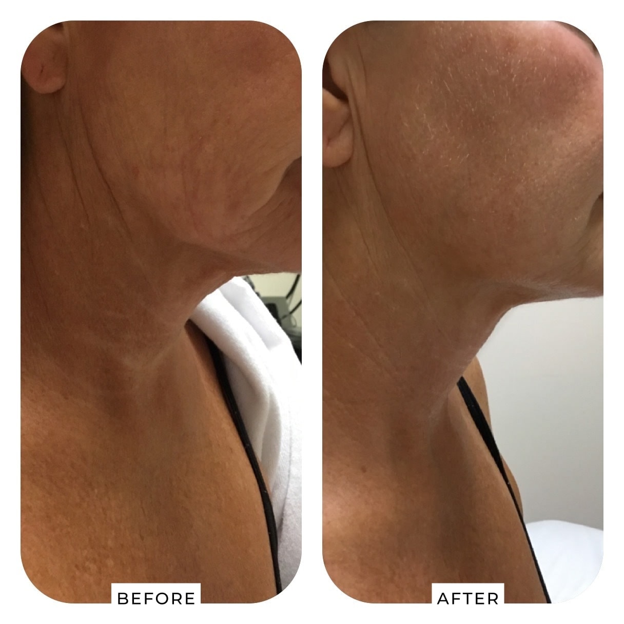 After — Pellevé®